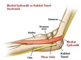 Ulnar Sinir Belirtileri ve Tedavisi Ulnar Sinir Belirtileri ve Tedavisi